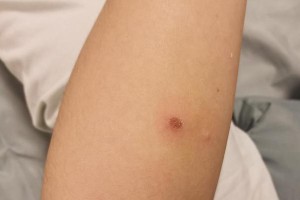 被猫抓过的症状（了解被猫抓伤的常见症状及应对方法）