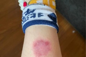 真菌性皮肤病的常见致病菌及其特征（揭秘真菌性皮肤病的主要真凶及其致病特性）